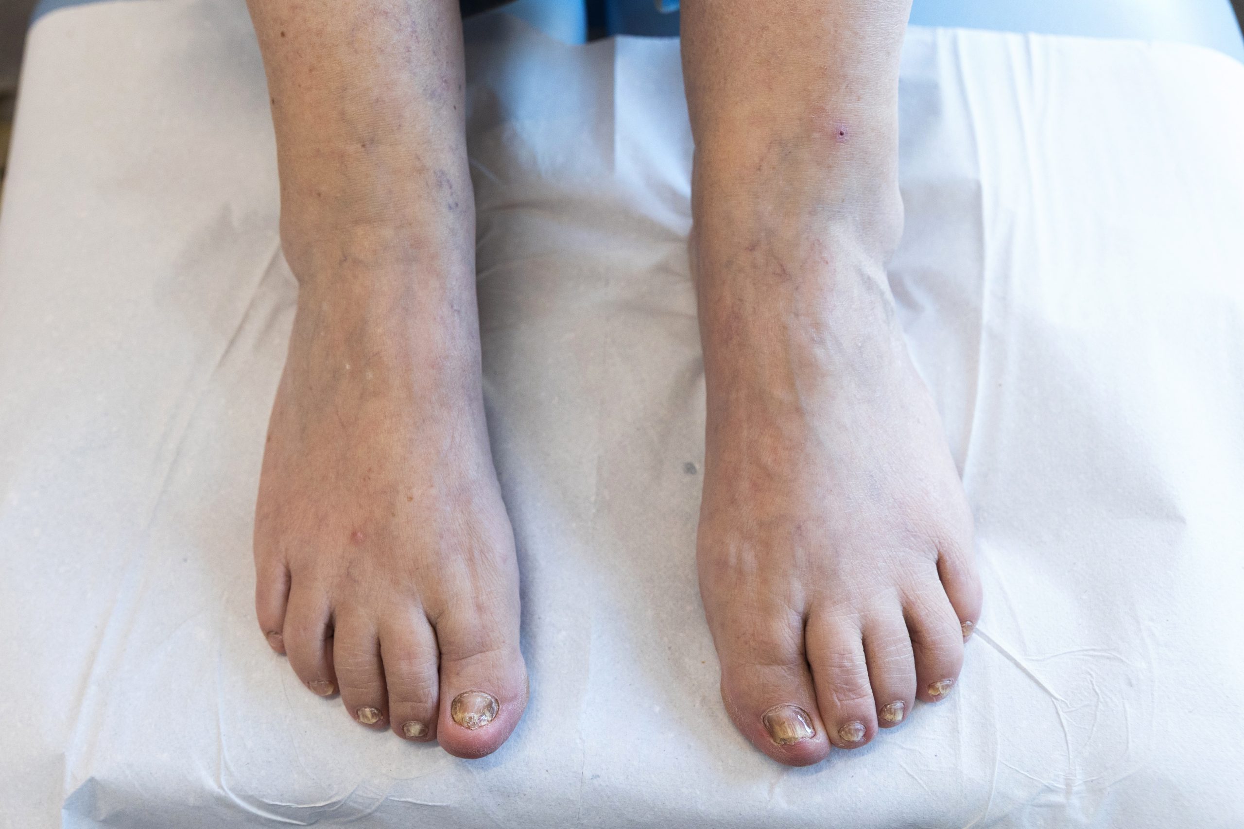 Fungal nail infections