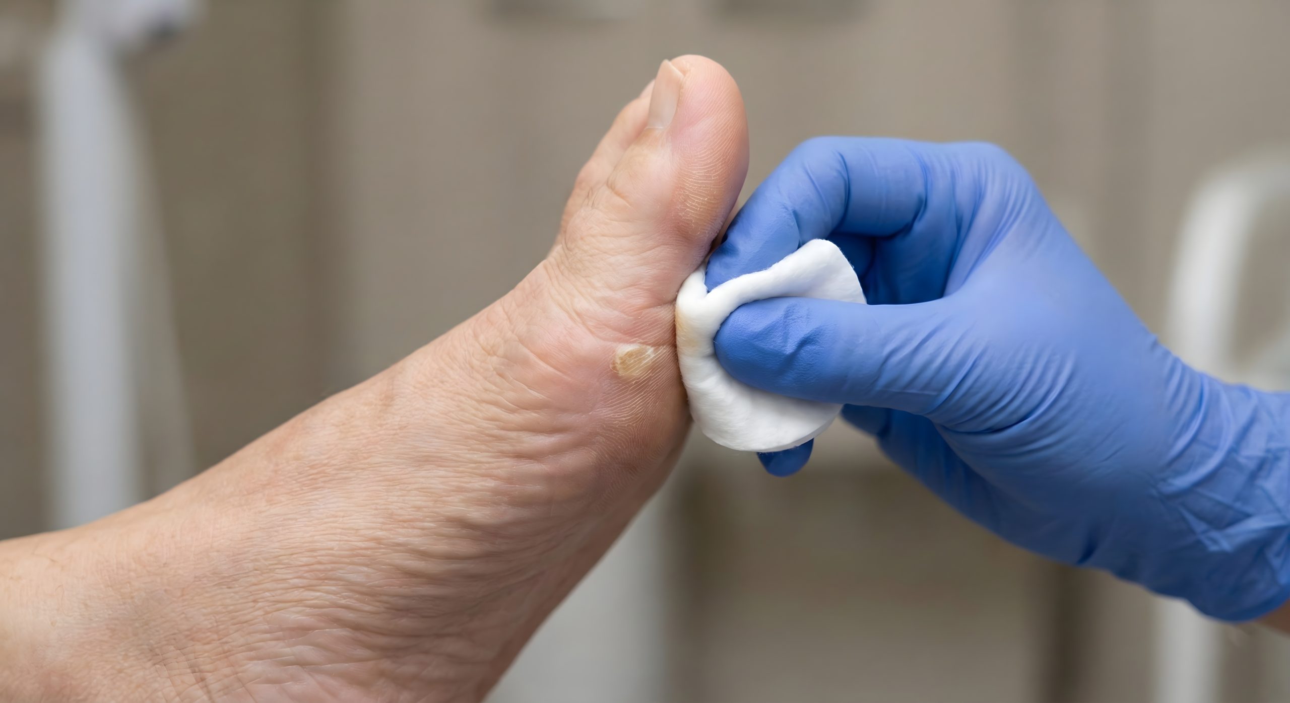 Corns and hard skin treatment