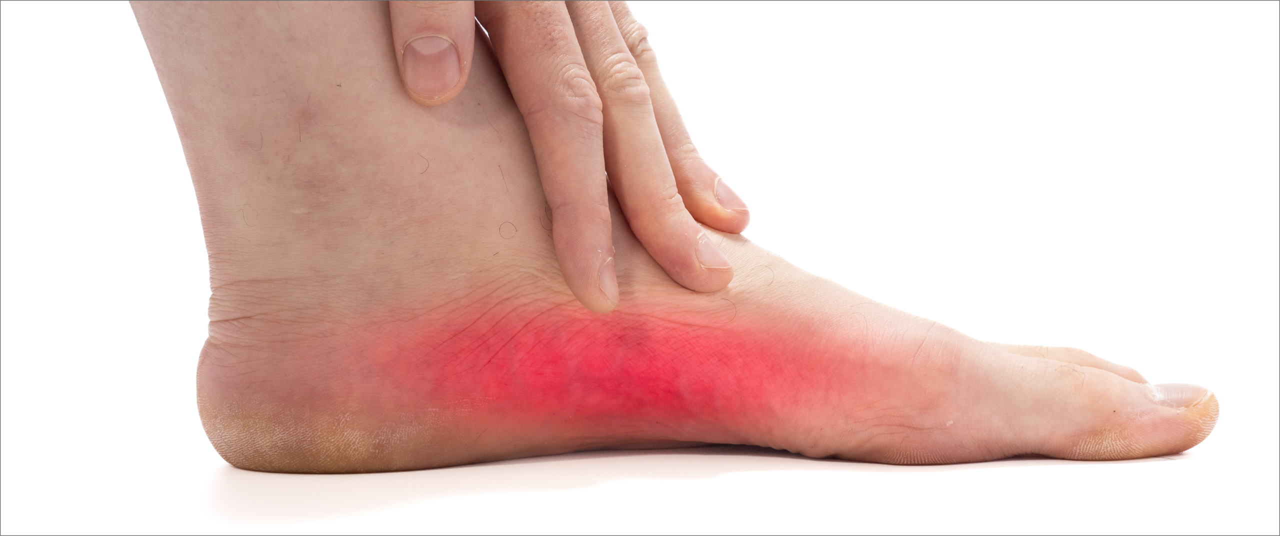 Posterior tibial tendon dysfunction