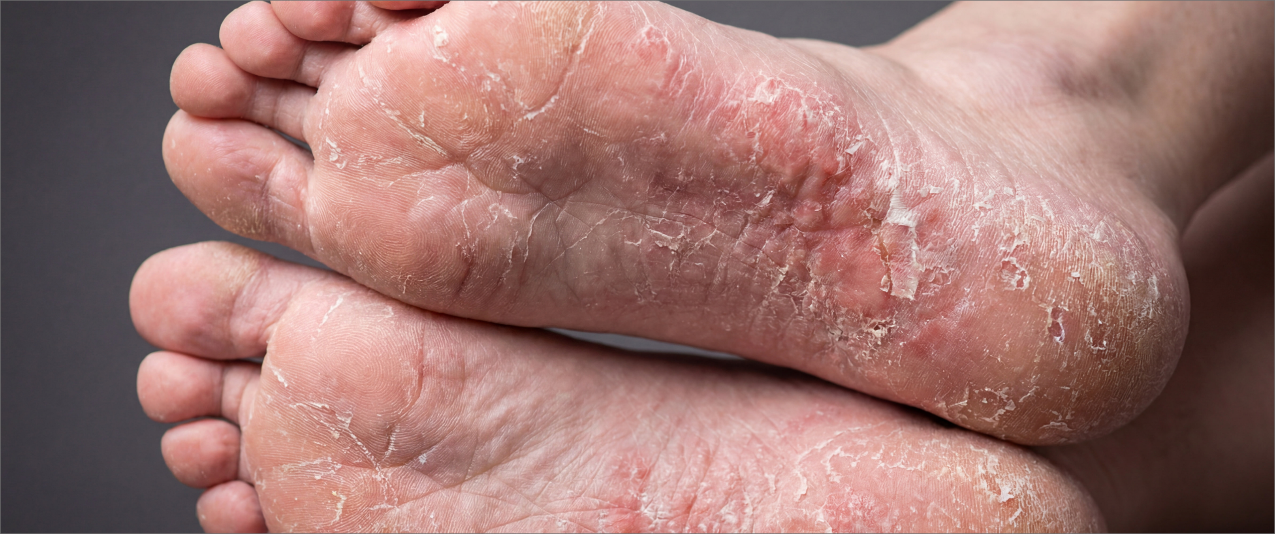 Skin lesion treatment