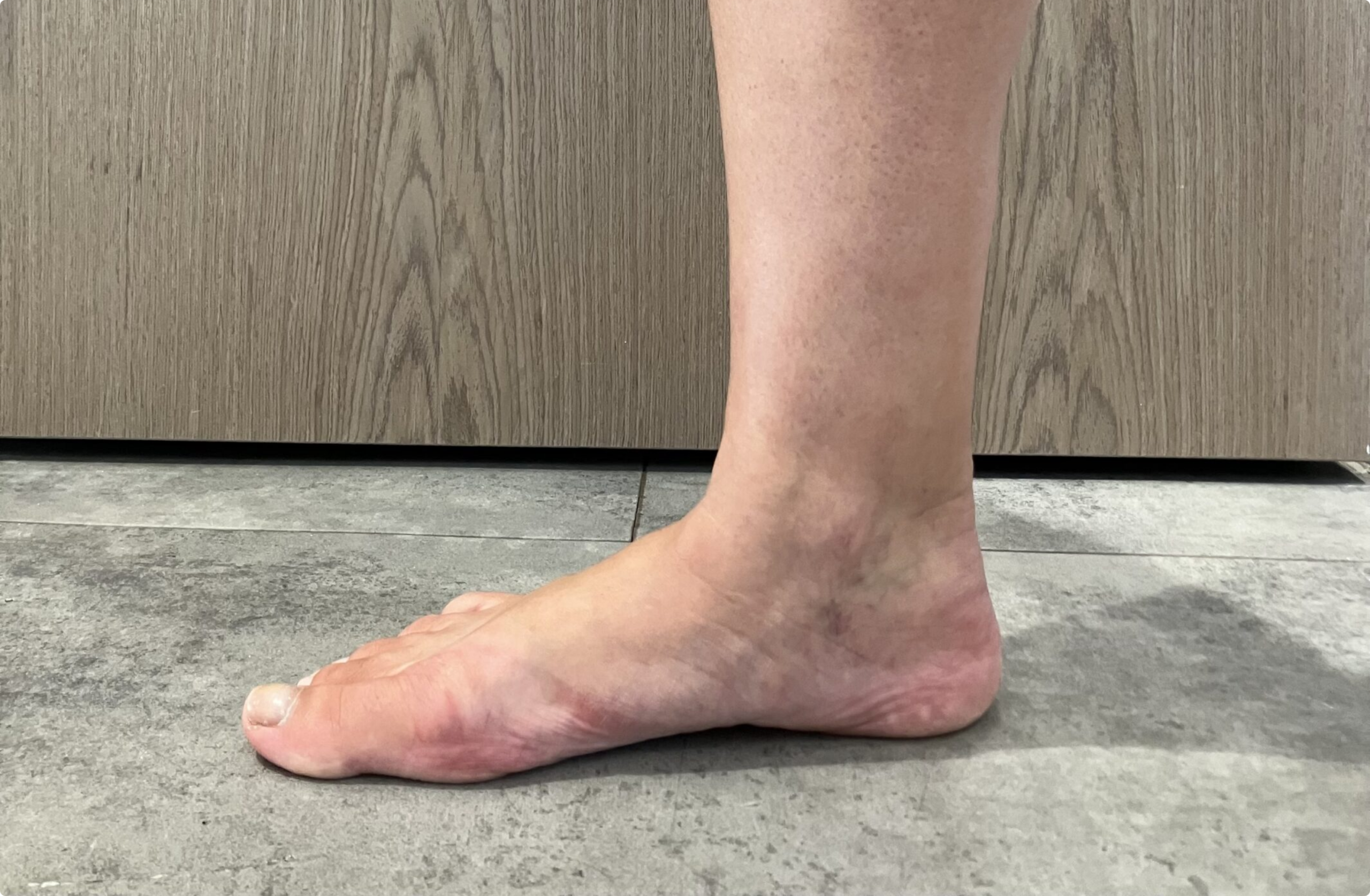 Flat feet treatment