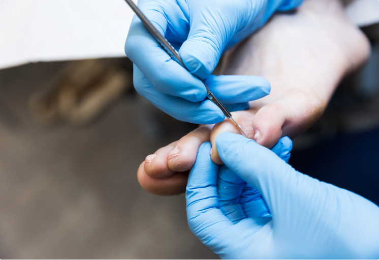 Podiatrist examining a verruca